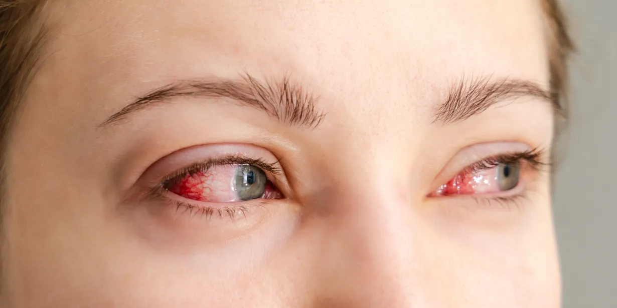 bloodshot eyes banner