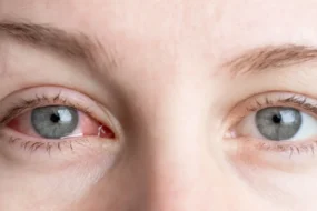 dry eyes banner image