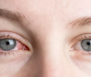 dry eyes banner image