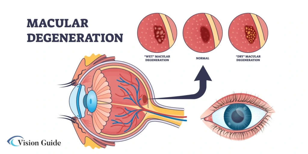 types of macular degeneration 