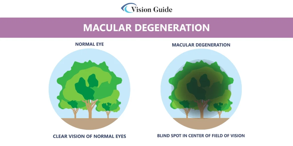 what is macular degeneration