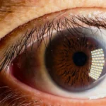 Diabetic Retinopathy