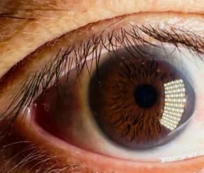 Diabetic Retinopathy