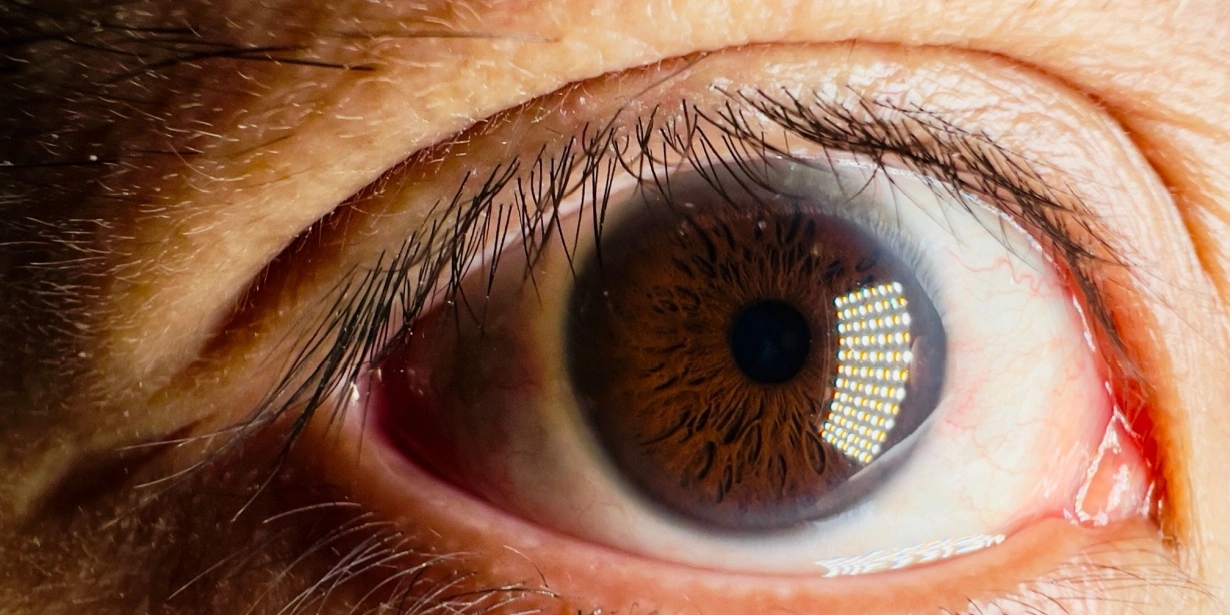 Diabetic Retinopathy