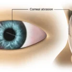 corneal abrasion