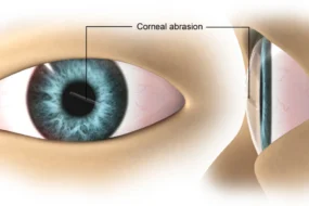 corneal abrasion