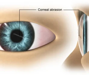corneal abrasion