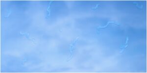 eye floaters in vision