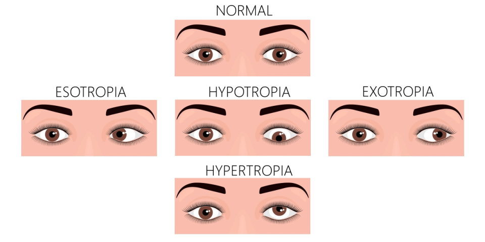 normal human eyes and eyes with problem