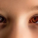 strabismus banner image