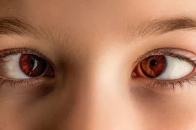 strabismus banner image
