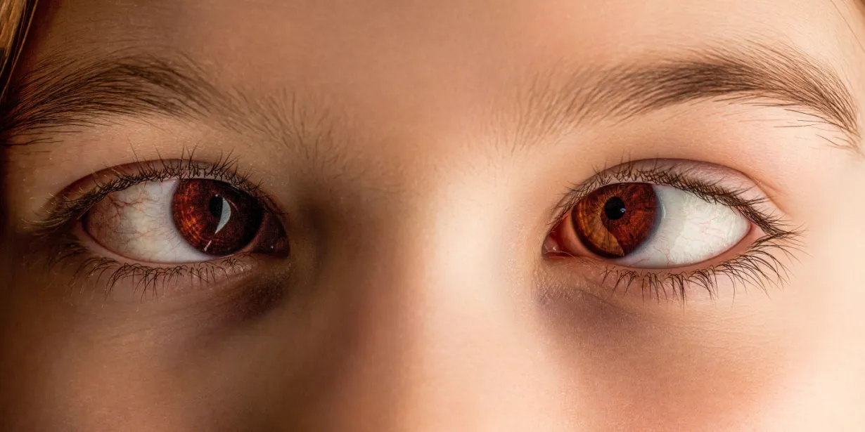 strabismus banner image