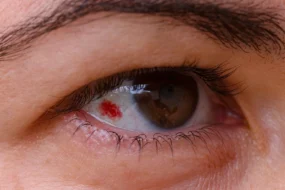 Subconjunctival Haemorrhage (Burst Blood Vessel in Eye)