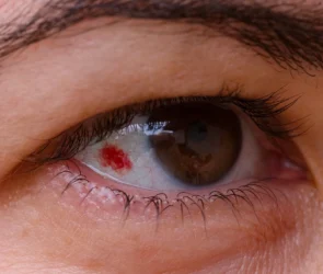 Subconjunctival Haemorrhage (Burst Blood Vessel in Eye)