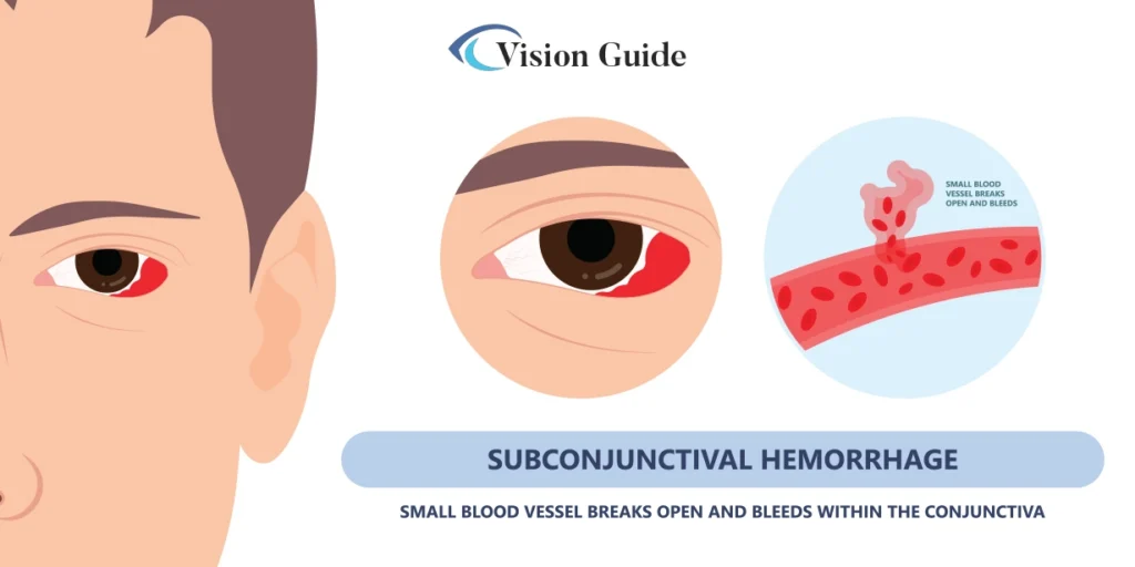 Subconjunctival Haemorrhage