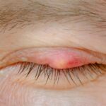 eyelid cysts