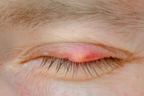 eyelid cysts