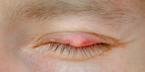 eyelid cysts