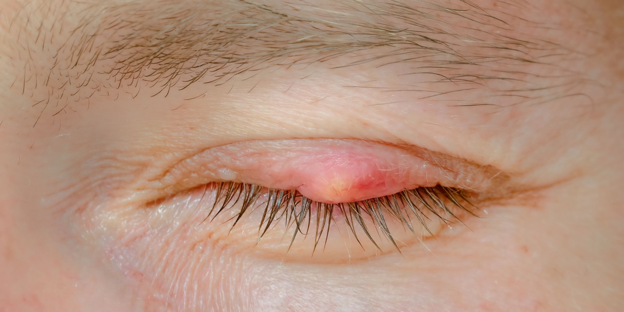 eyelid cysts