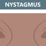 Nystagmus