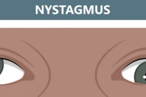 Nystagmus
