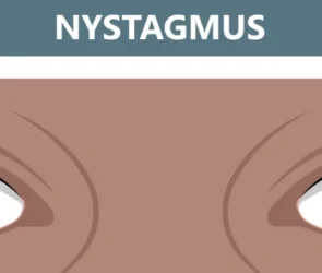 Nystagmus