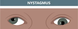 Nystagmus