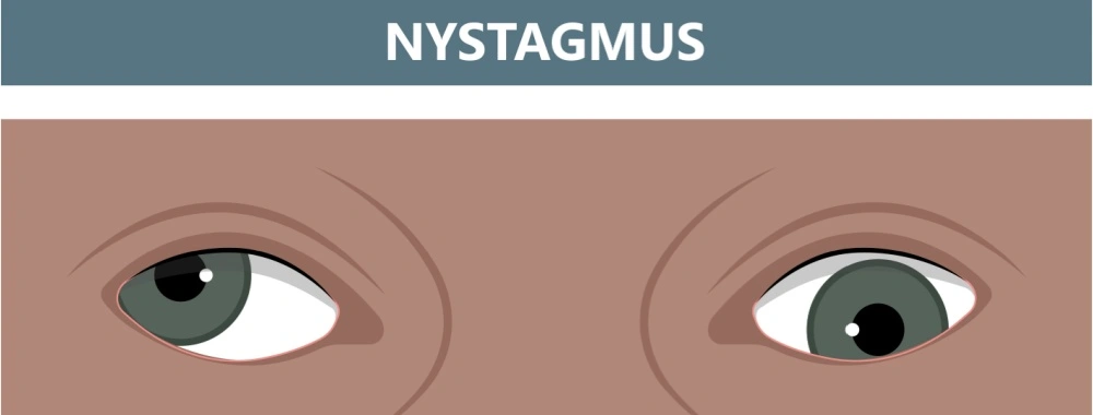 Nystagmus